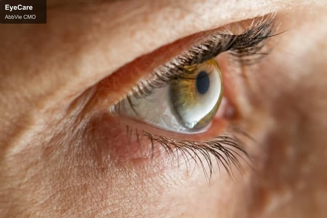 AbbVie CMO offer service "EyeCare"